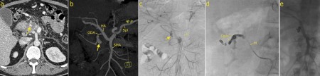 Embolization for GI haemorrhage