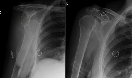 Anterior shoulder dislocation