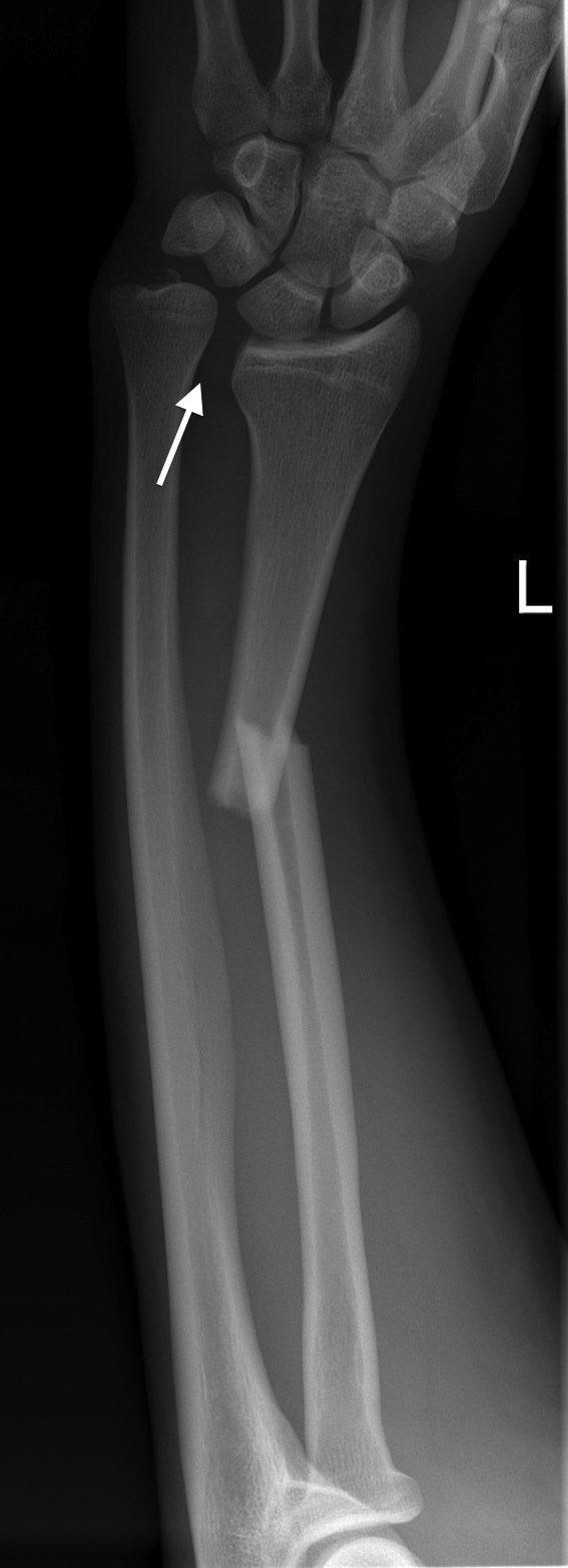 Galleazzi Fracturedislocation Radiology At St Vincents University