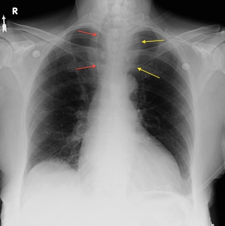 Widened superior mediastinum