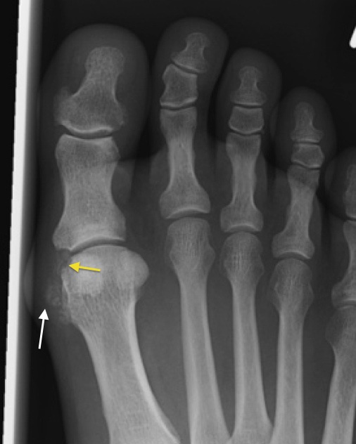 Metatarsophalangeal közös arthritis