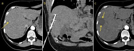 Radiofrequency ablation – HCC