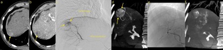 Transarterial chemoembolization (TACE) – HCC