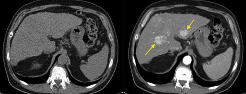 This example illustrates how much we can miss when forced to perform a non-contrast CT in someone with renal failure or a contrast allergy. The image on the left, from a triphasic CT liver, has been performed without contrast; the liver looks a little bit nodular (the patient had cirrhosis) but otherwise fine. On the right is an image from the arterial phase of the CT, taken at the same position - it shows multifocal hepatocellular carcinoma (arrows).