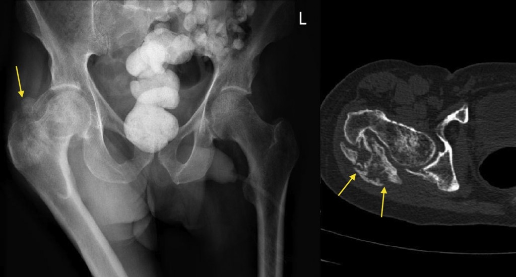 Heterotopic ossification - Radiology at St. Vincent's University Hospital