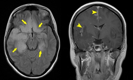 Herpes simplex encephalitis