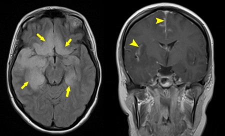 Herpes simplex encephalitis