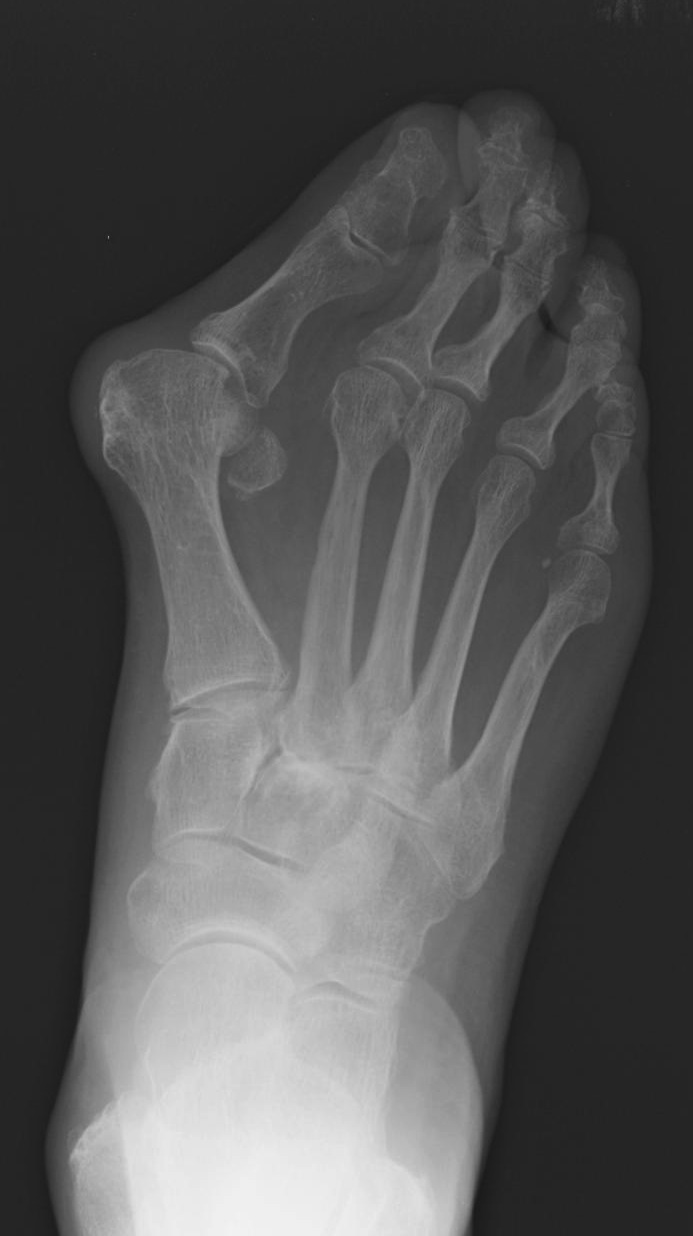 Hallux valgus - Radiology at St. Vincent's University Hospital