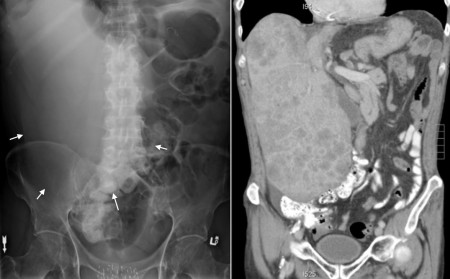 Hepatomegaly due to metastases