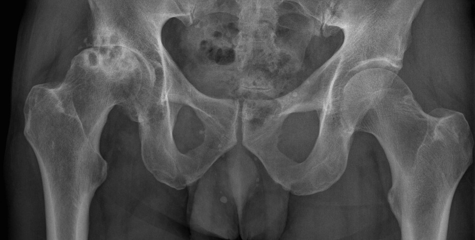 osteoarthritis radiology hip)