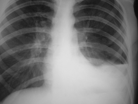 Hydropneumothorax – CXR