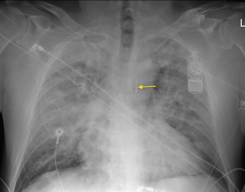 Intra aortic balloon pump Radiology at St. Vincent s University