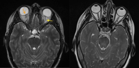 Benign intracranial hypertension