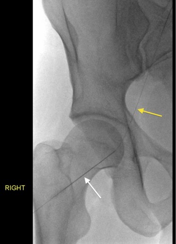 Femoral artery access for an arterial embolization. 