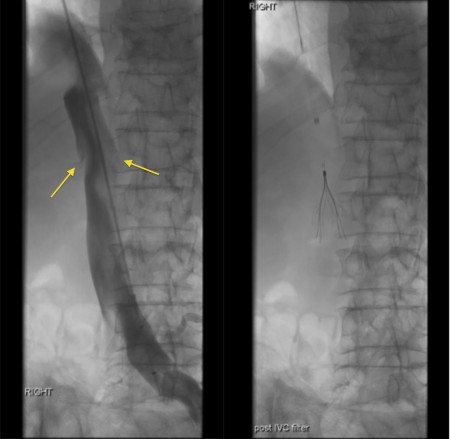 IVC filter insertion