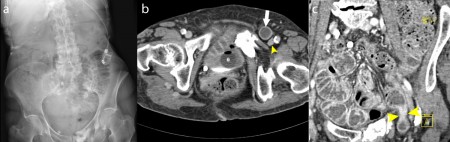 Incarcerated Femoral Hernia