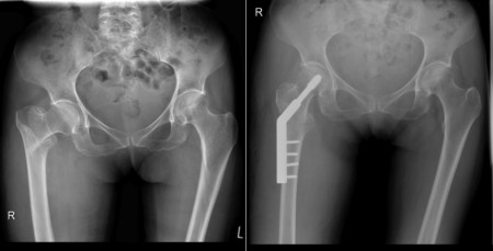 Intertrochanteric fracture