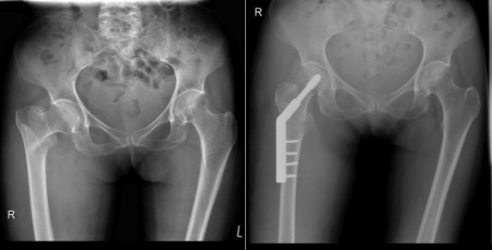 Intertrochanteric fracture