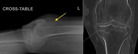 Lipohaemarthrosis of the knee