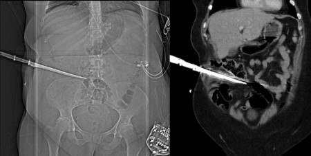 Penetrating trauma