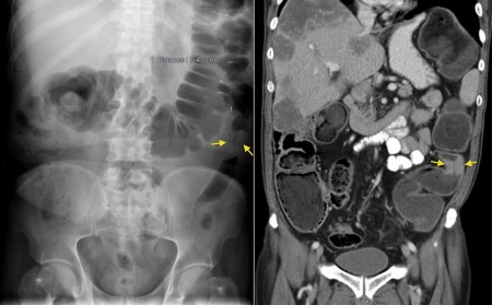 Large bowel obstruction