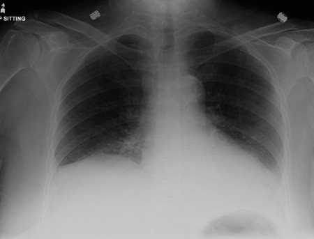 Left lower lobe consolidation