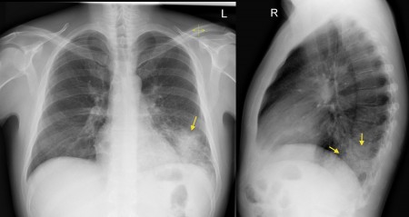 Left lower lobe pneumonia – lateral CXR