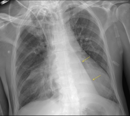 Left lower lobe collapse