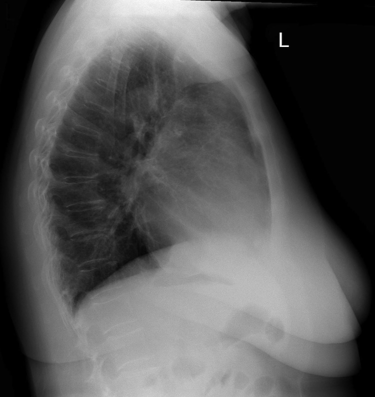 Chest (lateral) - Radiology at St. Vincent's University Hospital
