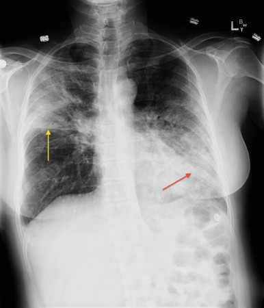 Right upper lobe and lingular consolidation