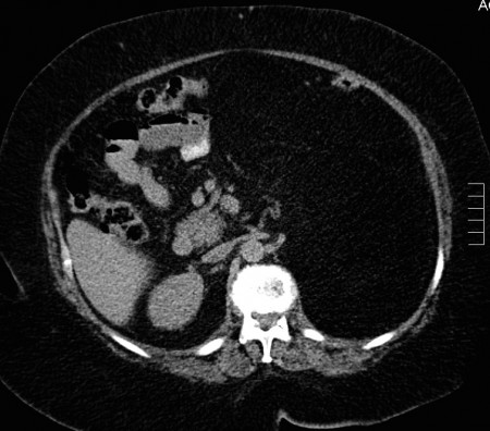 Retroperitoneal liposarcoma