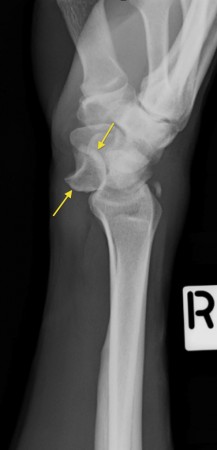 Lunate dislocation