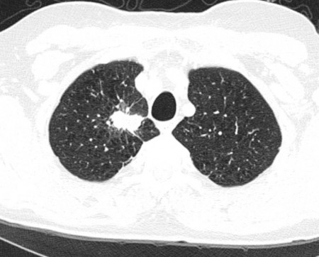 Primary lung cancer