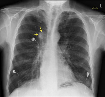 Lung cancer – CXR