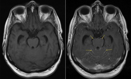 Meningeal metastases