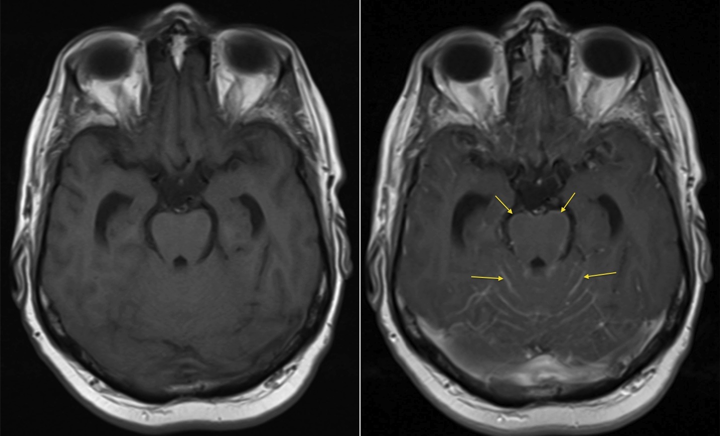 Meningeal metastases - Radiology at St. Vincent's University Hospital
