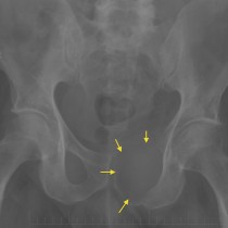 Lung cancer with bone metastasis  Radiology at St. Vincent\u002639;s University Hospital