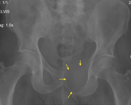 Lytic bone metastasis