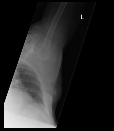 Inferior shoulder dislocation