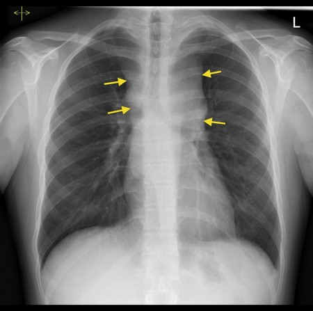 Mediastinal widening – CXR