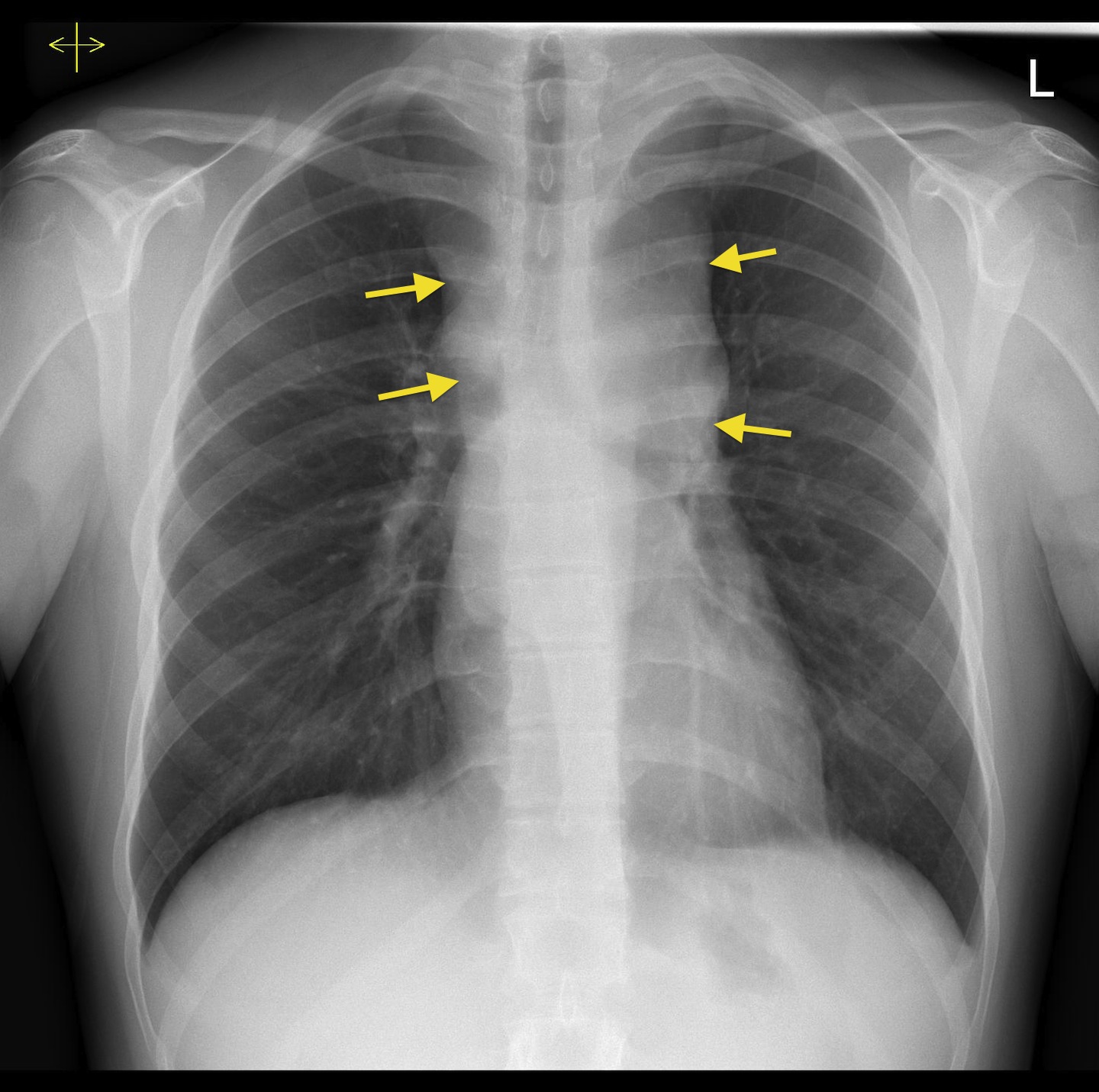 Mediastinal Widening Cxr Radiology At St Vincents University Hospital