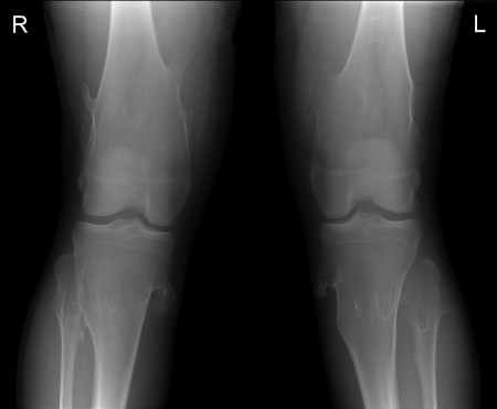 Multiple hereditary exostoses