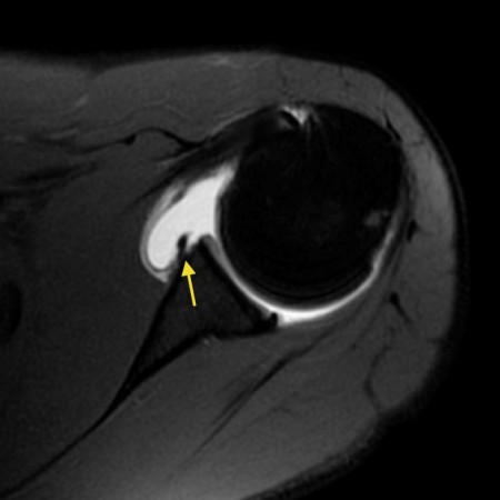 Glenoid labral tear