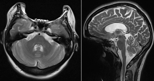 Another example of the detrimental effect of metal on MR images - in this case, it looks like half of the patient's face is missing. This bizarre appearance is caused by dental braces.