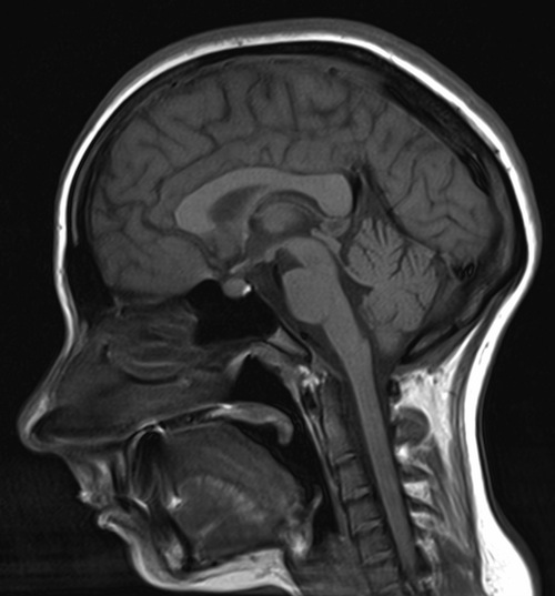 Sagittal MRI Brain (T1w) - Radiology at St. Vincent's University Hospital