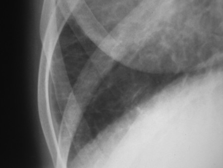 Pulmonary oedema