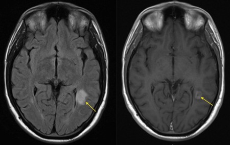 Multiple sclerosis – enhancing plaque