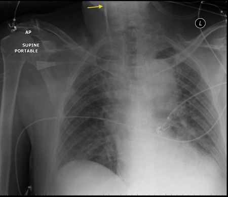 Malpositioned subclavian line