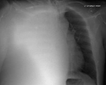 Massive pleural effusion