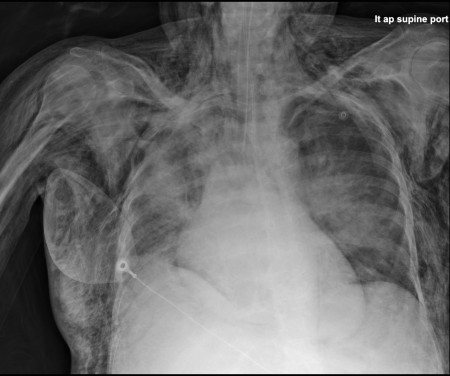 Massive surgical emphysema